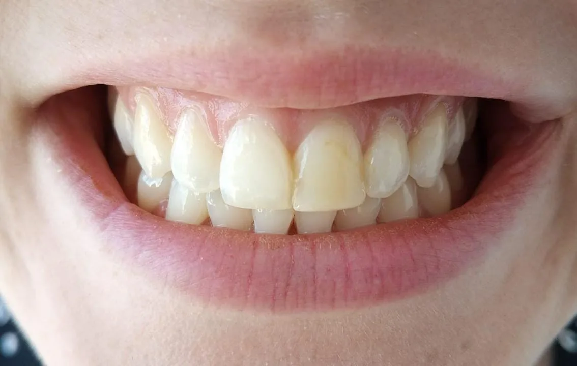 Before teeth whitening
